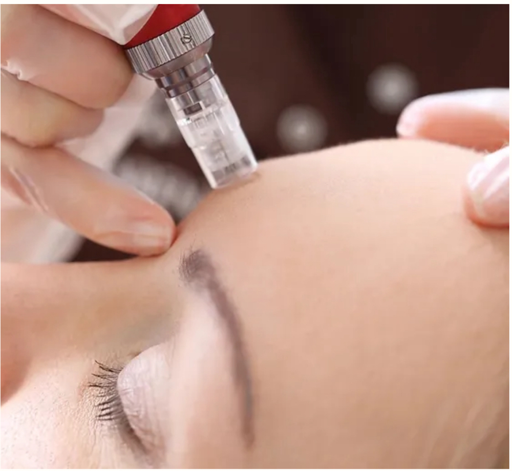 Microneedle (classic)