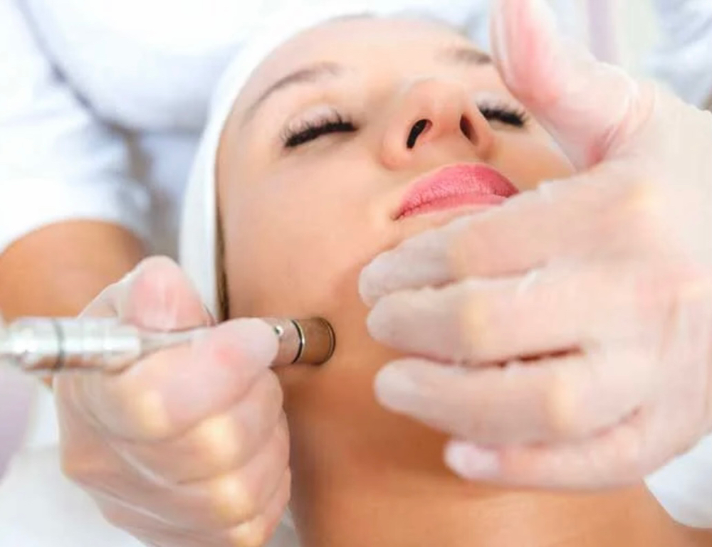 Microderm  Facial