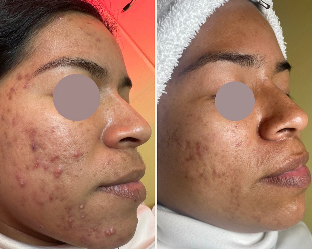 Acne Facial (1 Session)