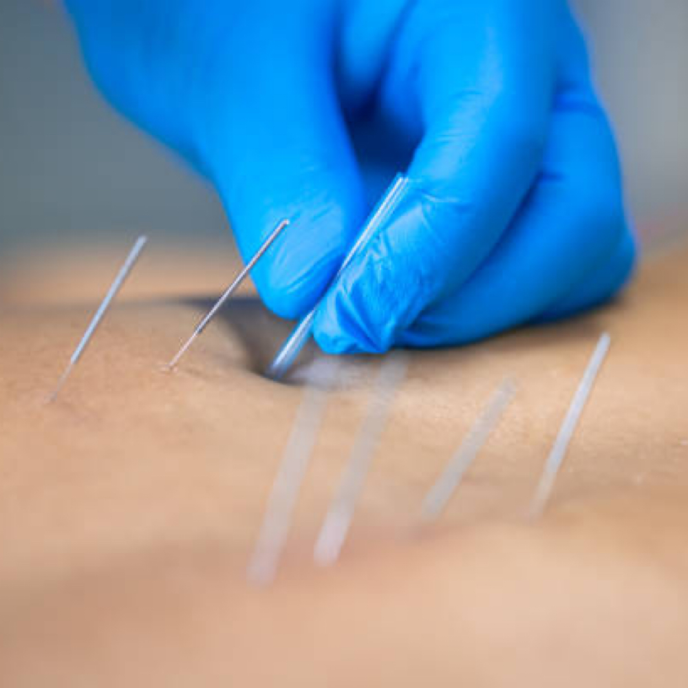 Dry Needling Therapy at Glo Body Co. in Trenton, MO