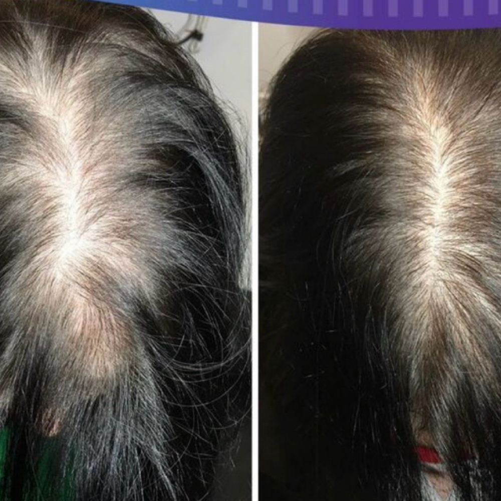 Hair Regrowth (FirstSessionSpecial) at It’s Your Beauty Time in Downey, CA