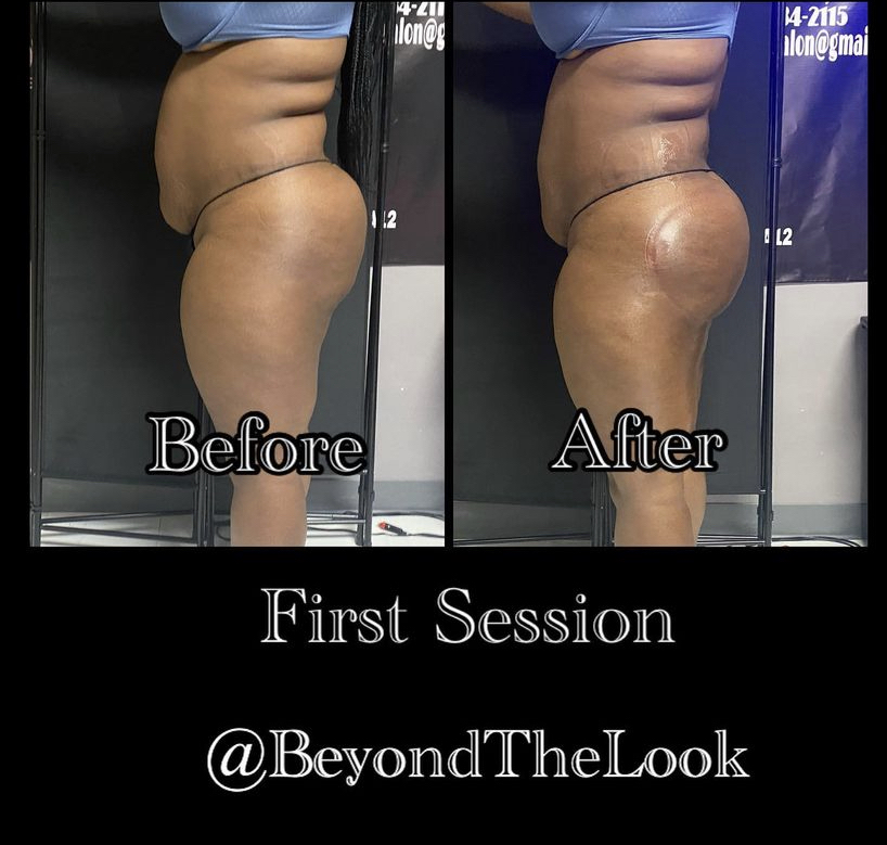 Laser Lipo /Lipo Cavitation