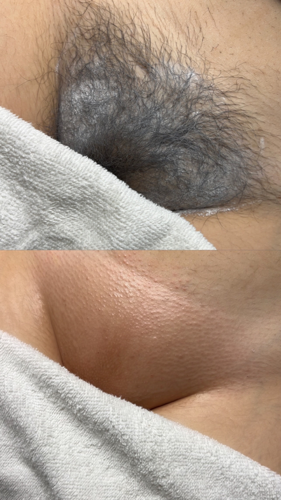 Brazilian Wax