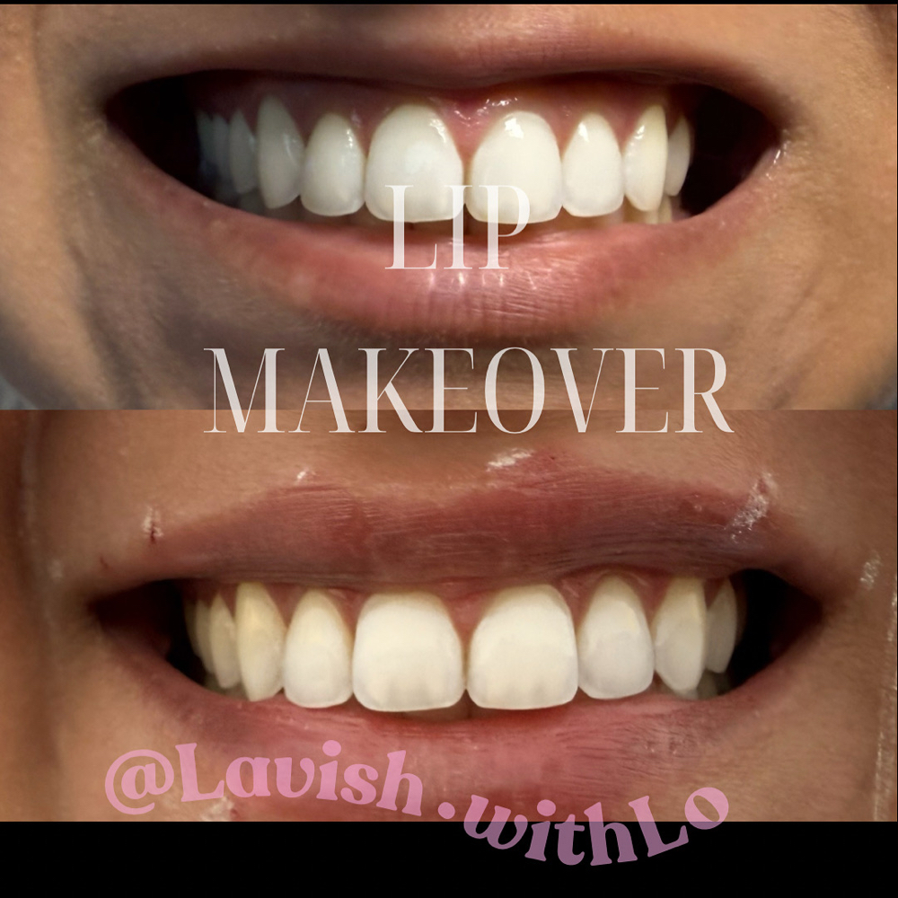 Lip Flip at Lavish.withLo in Sunnyvale, TX