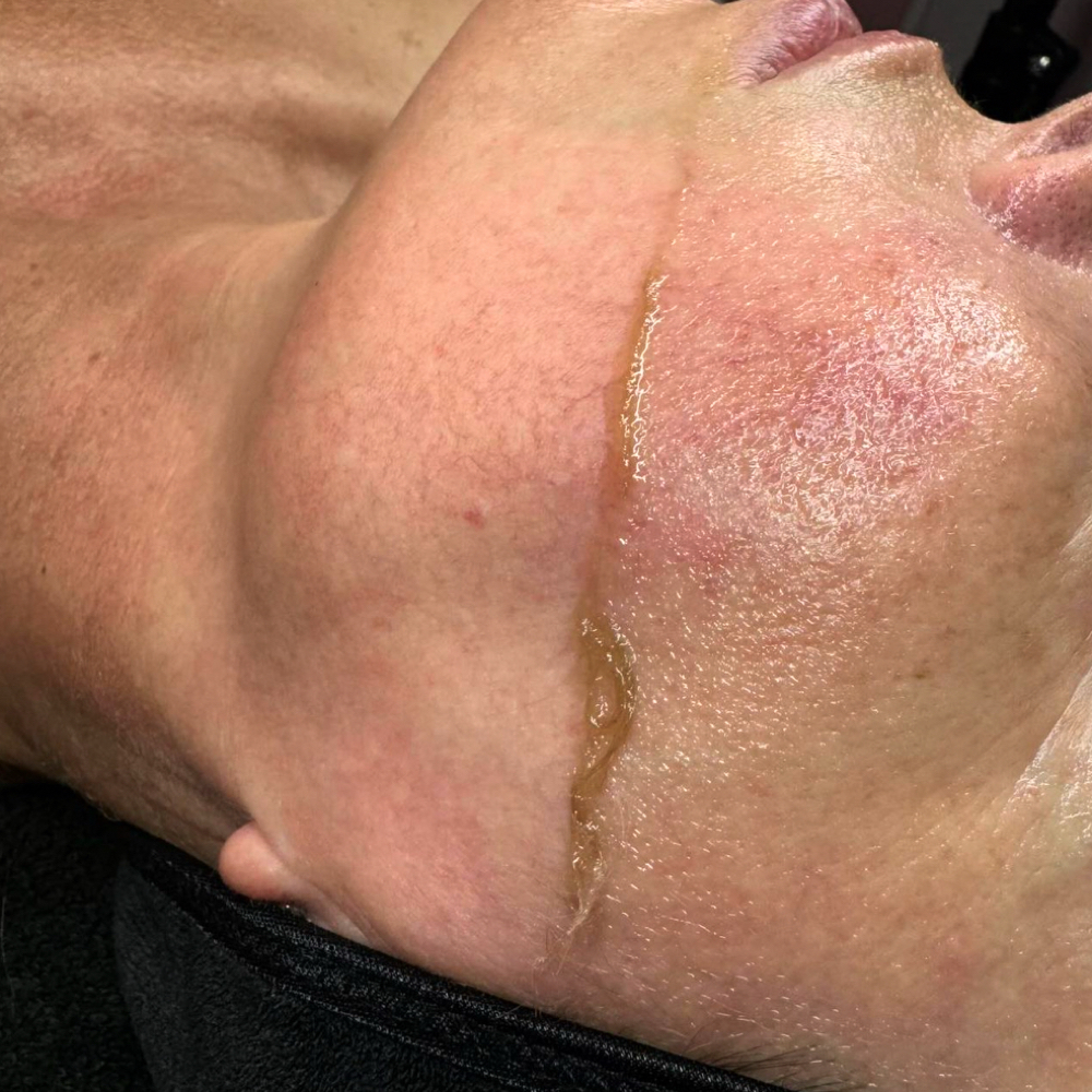 Derma-exfoliation Add On at Anointed Aesthetics LLC in Shelton, CT