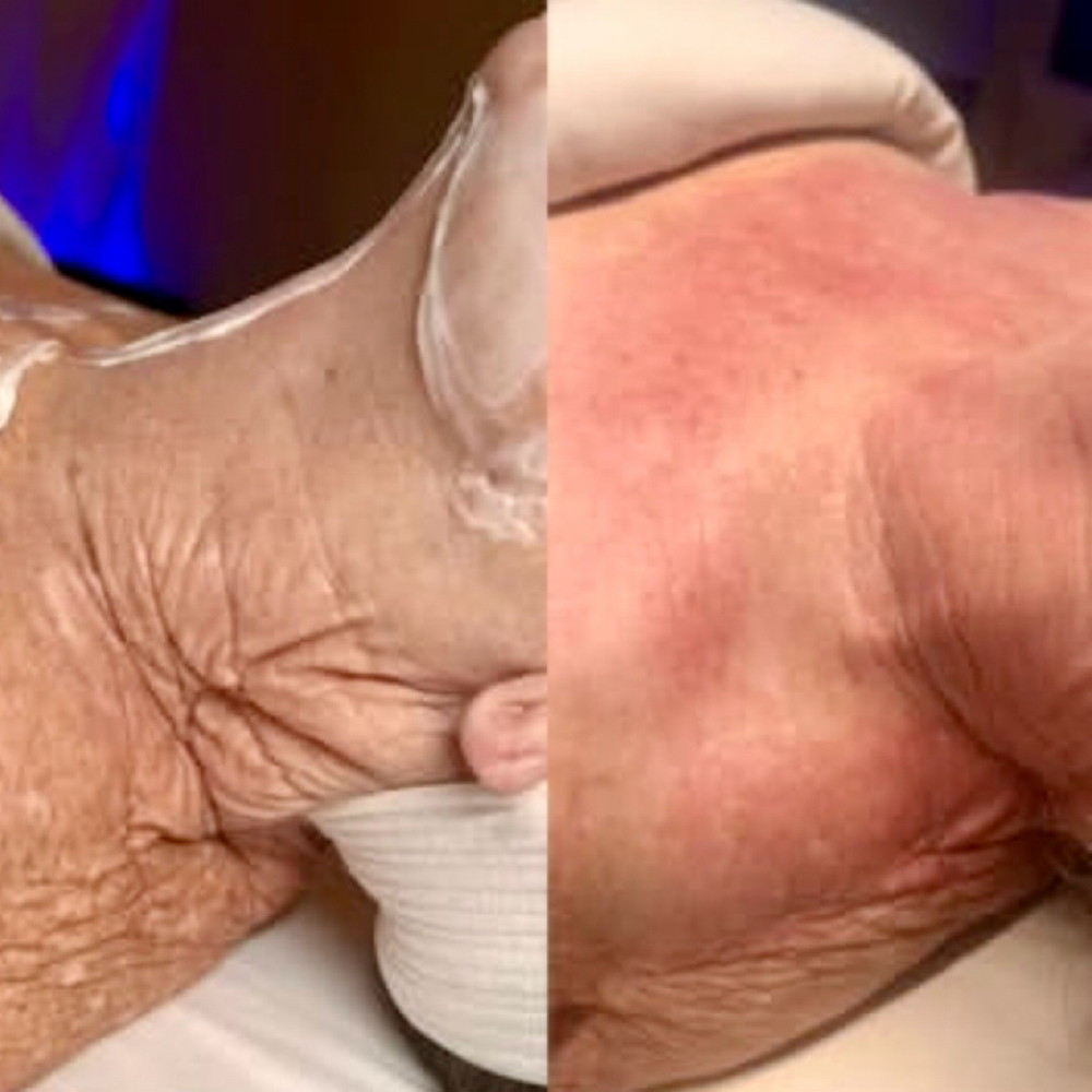 MicroChanneling Neck & Décolleté at After Glow Esthetics in Galt, CA