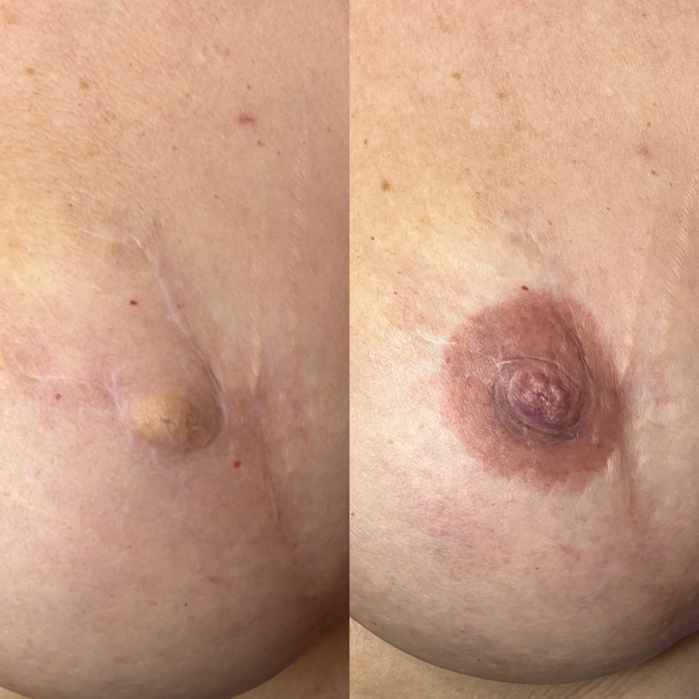 3D Areola Tattoo -unilateral