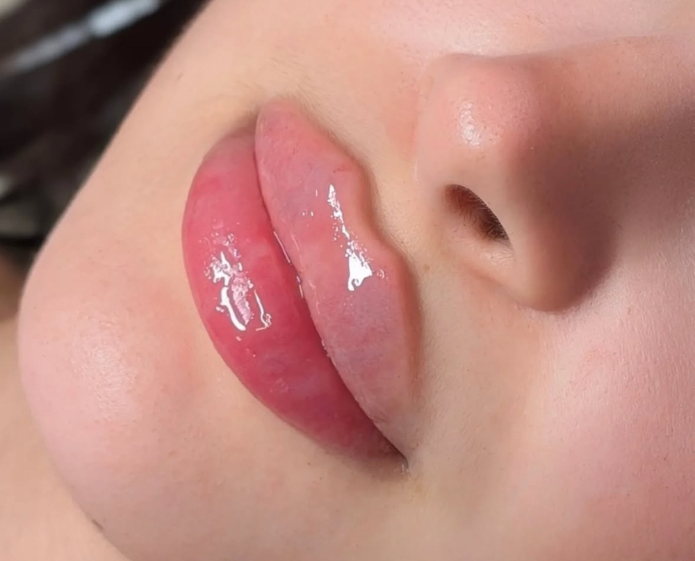 Lip Filler