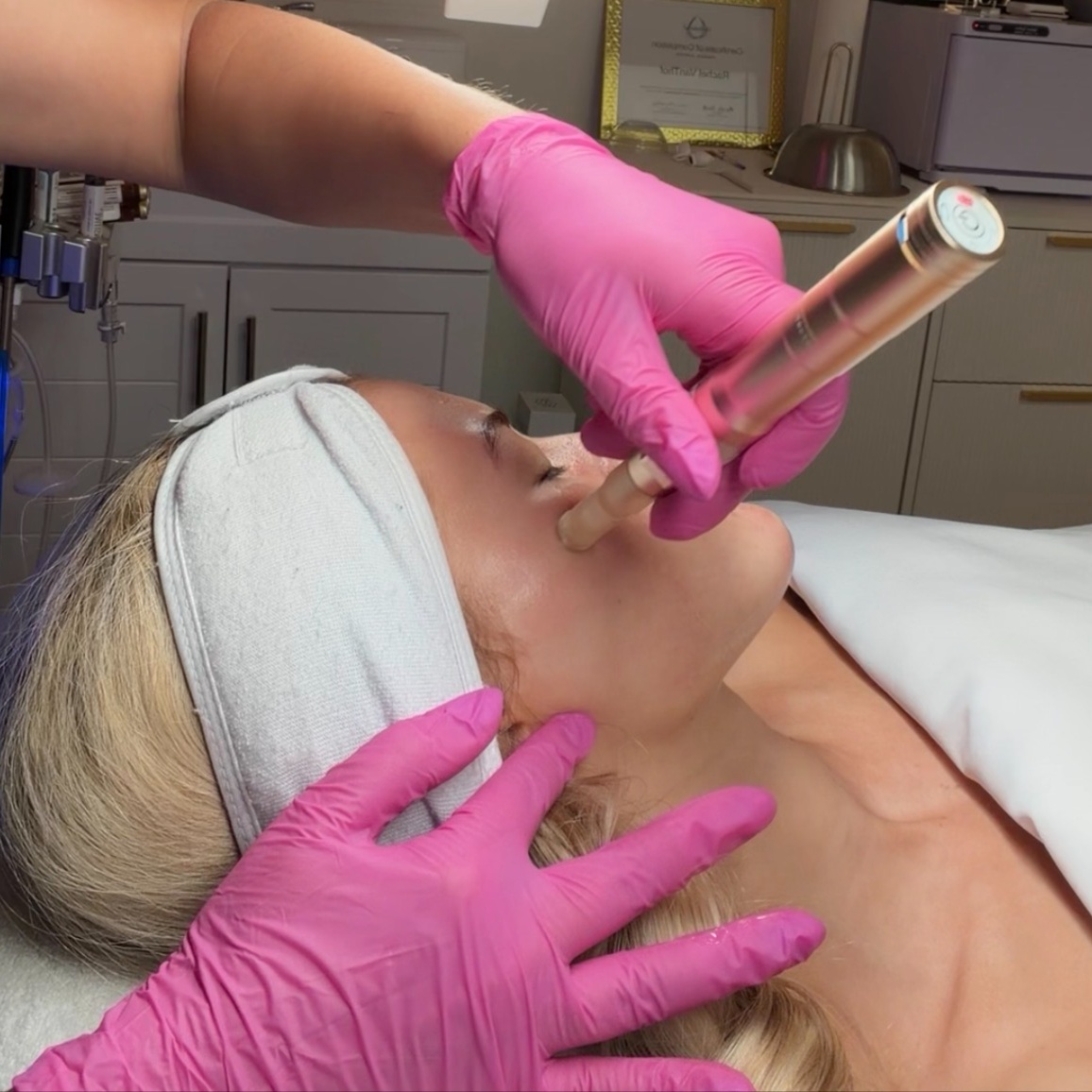 SkinStylus Microneedling at SKN by Rachel in Summerville, SC