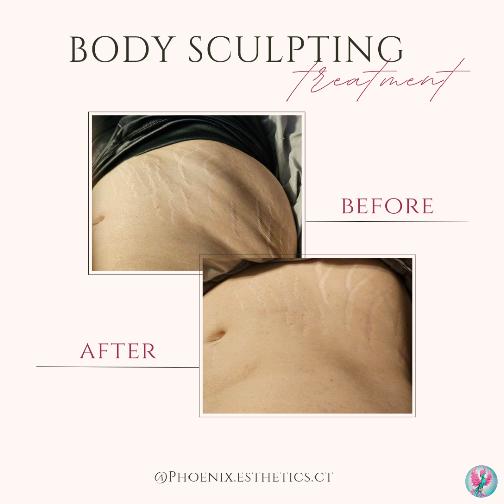 Cellulite And Body Contouring