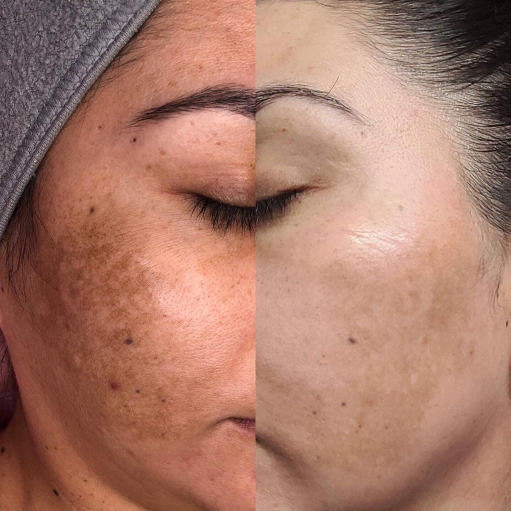 Peel / Get Glow Chemical Peel