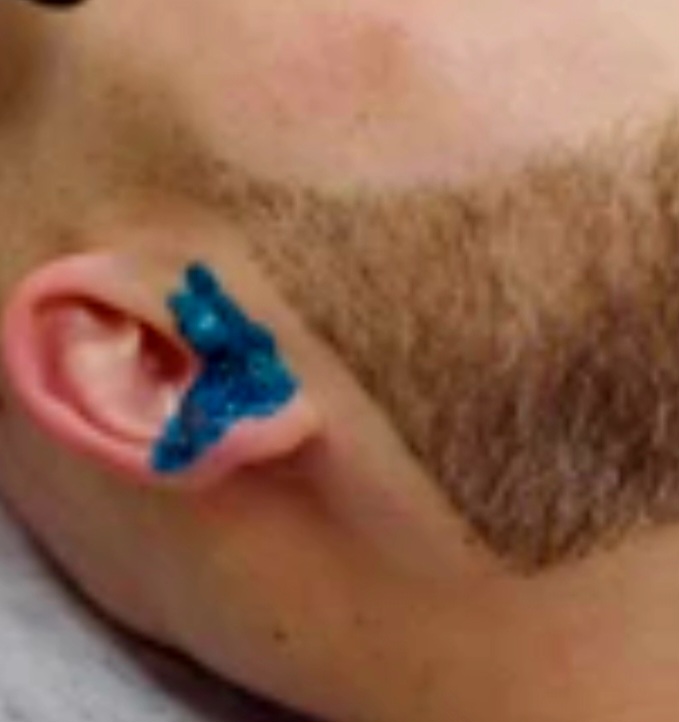 Ear Hair Removal – Men