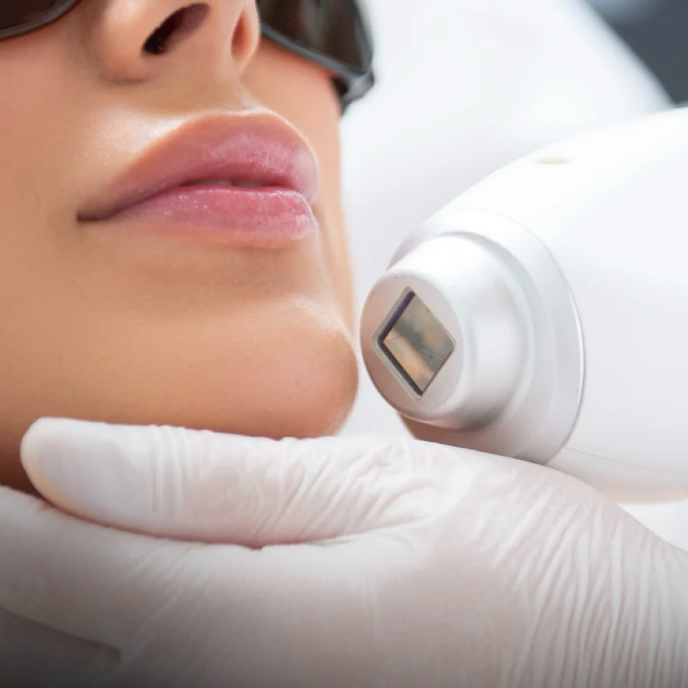 Chin Laser - 5 sessions at Blessed & Bare Laser Studio in New York, NY