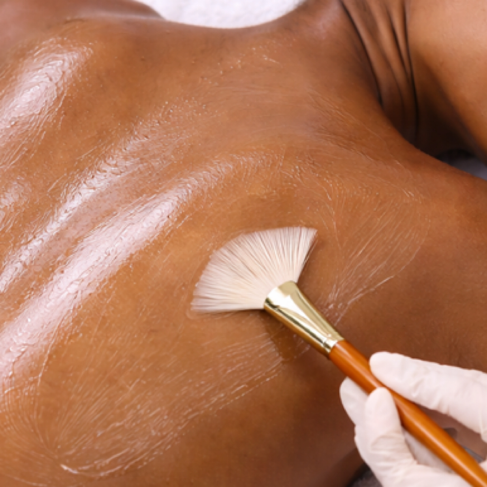 TCA Back Peel at TAYLUXE ESTHETICS in Charlotte, NC