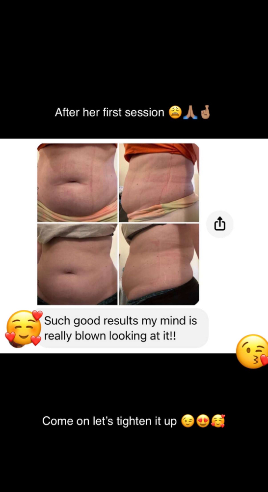 Laser Lipo at MarriGLoW in Sharon, PA