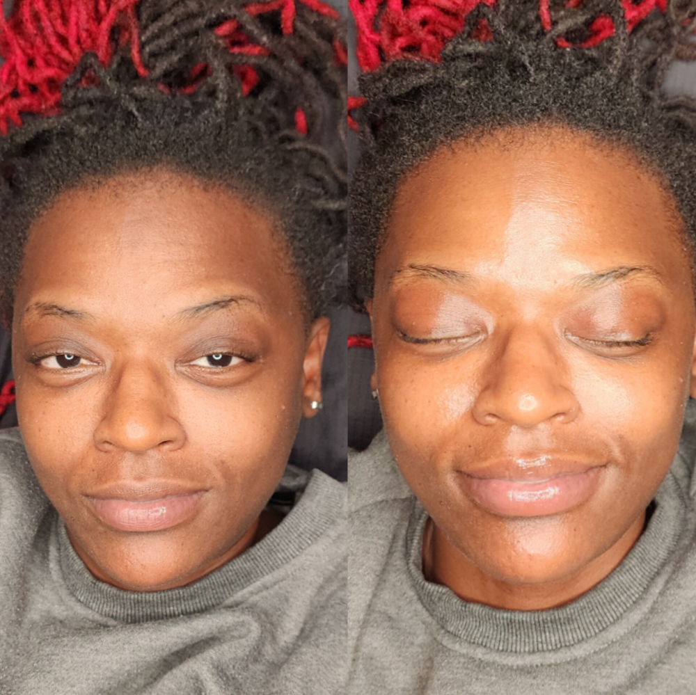 Consultation + Nanoinfusion Therapy