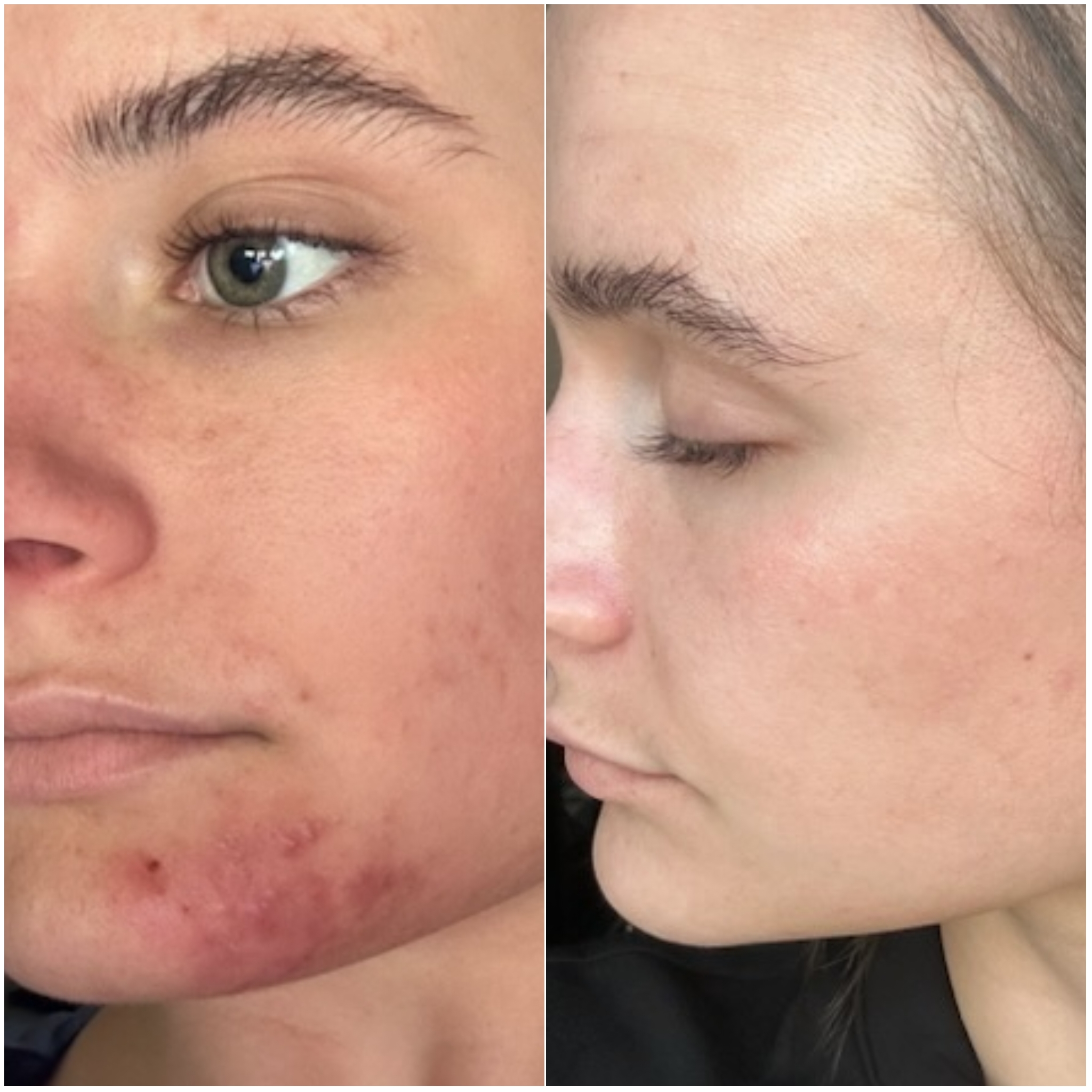 Virtual Acne Bootcamp