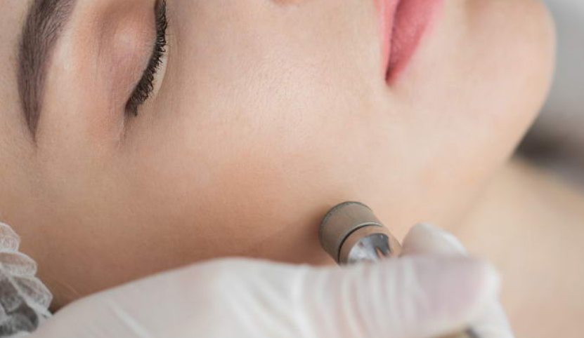 Diamond-Tip MicroDermabrasion