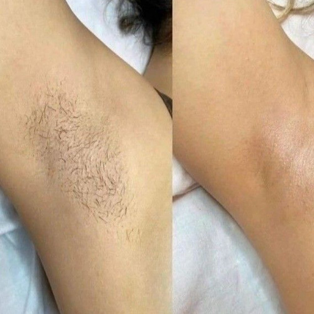 Underarm at Skin Revival Aesthetics in Ammon, ID