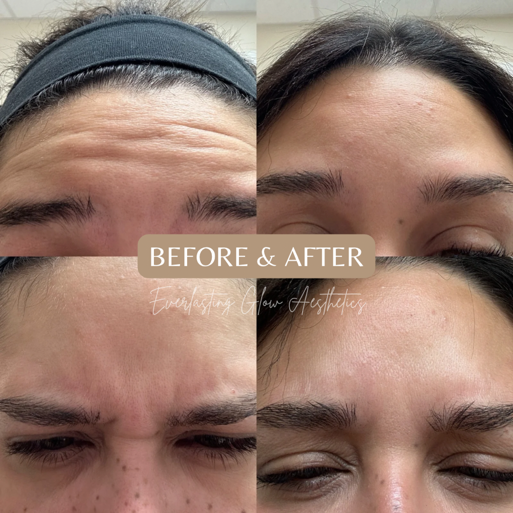 Baby Botox (frontalis, glabellar)