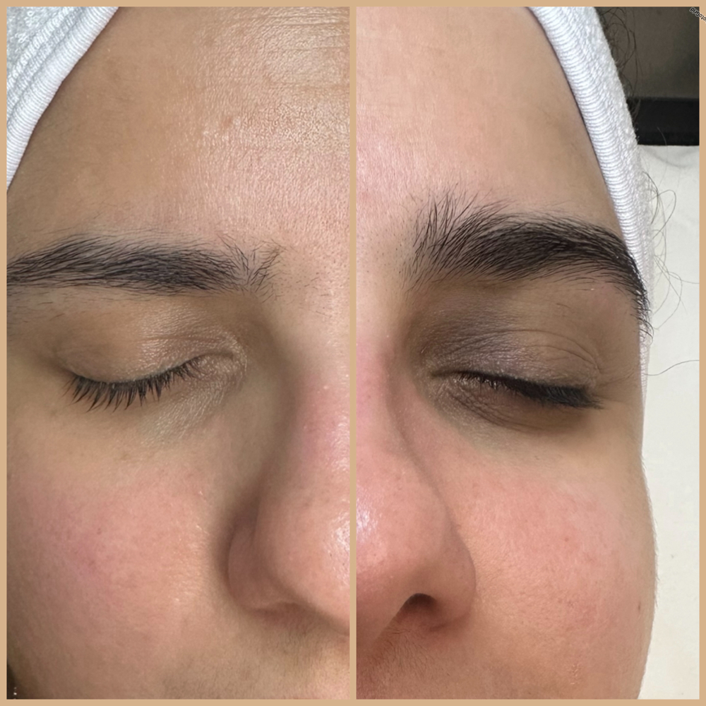 Periocular Eye Contour Peels