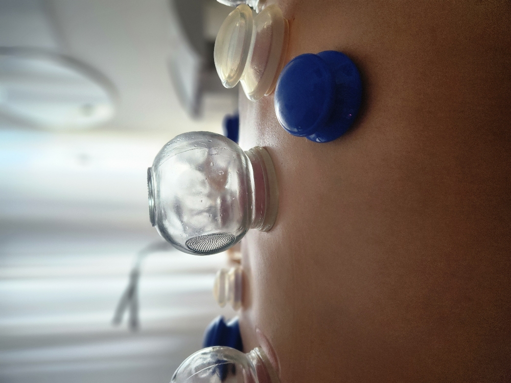 Cupping Therapy at The Floating Lotus in Pico Rivera, CA