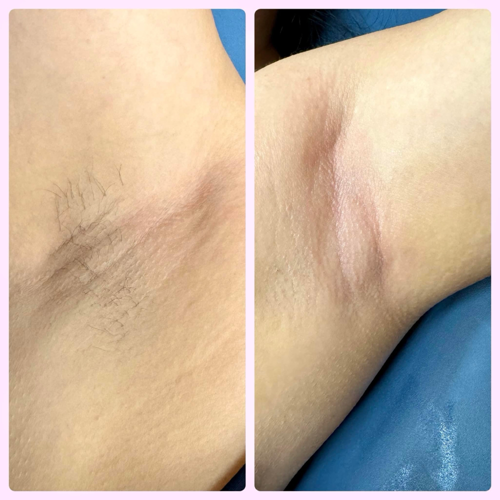 Underarm Wax