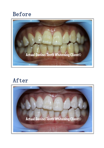Teeth Whitening at Elegant Esthetics By Jozlyn in Lamar, CO