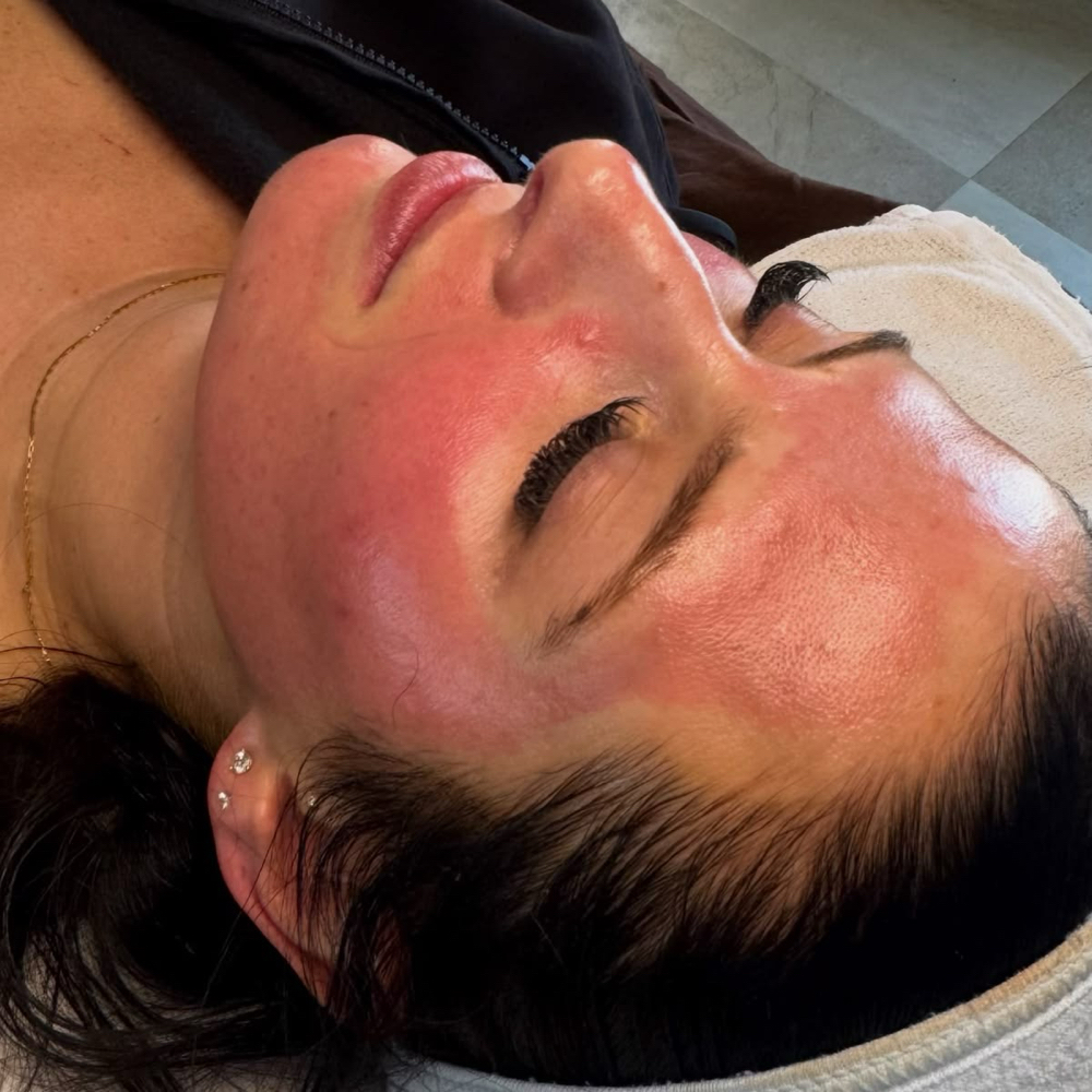 Microneedling Face+Neck, 3 Sessions at Aesthetics By Arely in Glendale, AZ