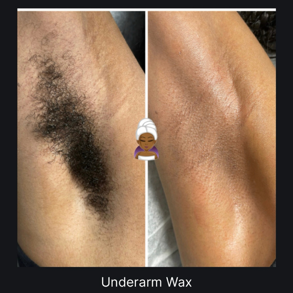 Underarm at Exquisite Touch Aesthetics in Jackson, GA