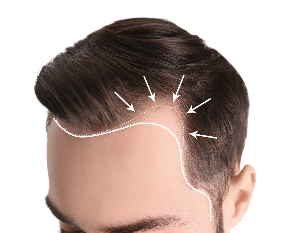 Hair Restoration (Procell)