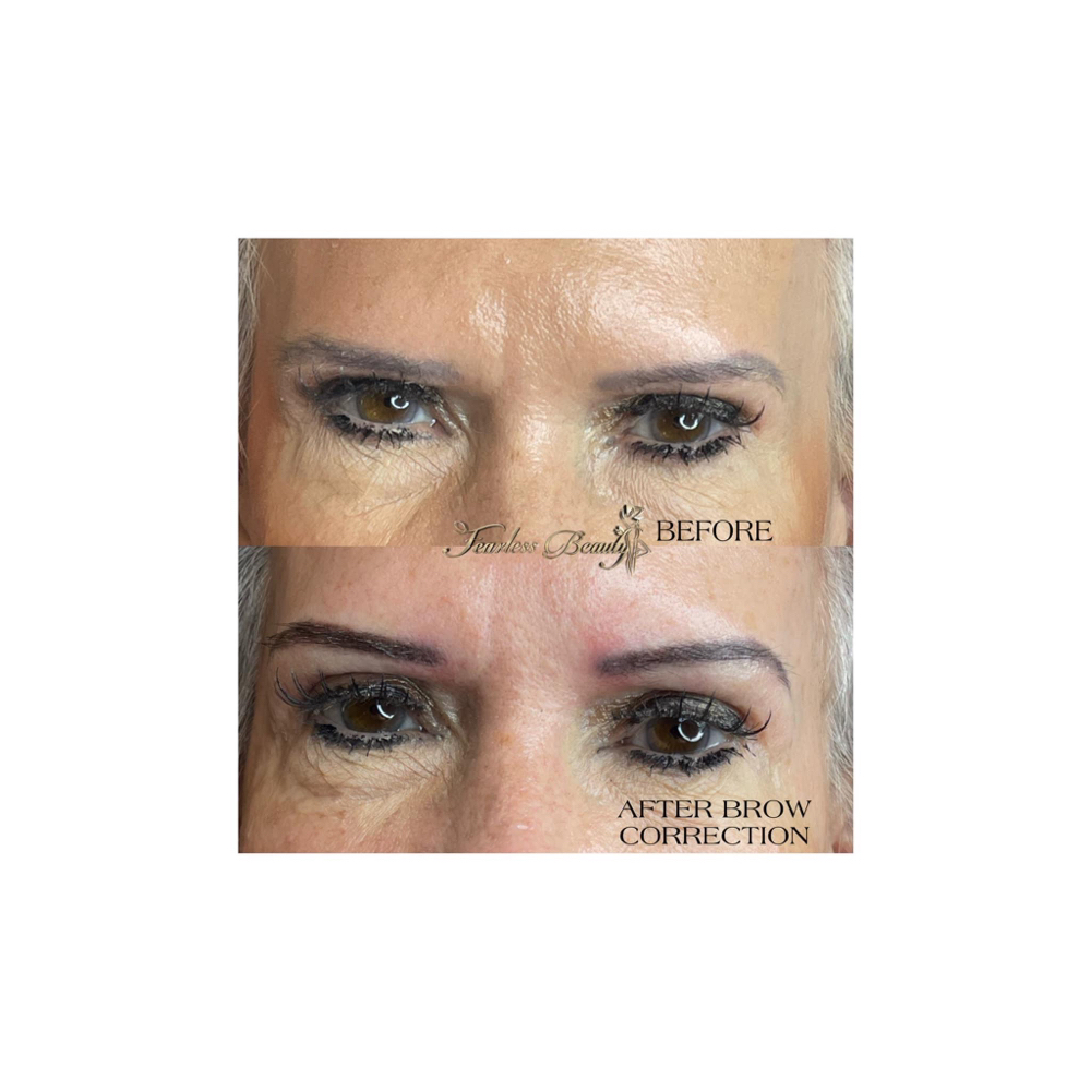 Brow Correction