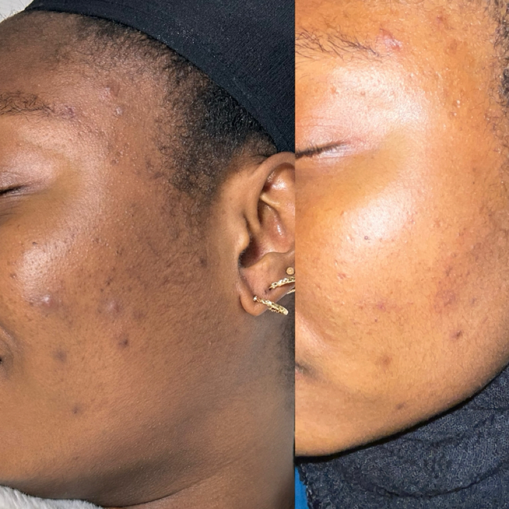 Skin Consultation & Skincare Routin at Prime Skin  Esthetics in Belleville, NJ