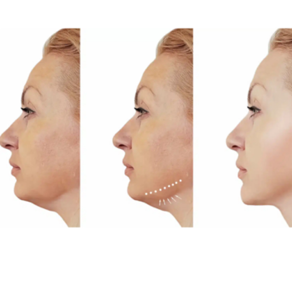 Four Chin/neck FD Sess at Finesse Sculpt Body Studio in Parkville, MD