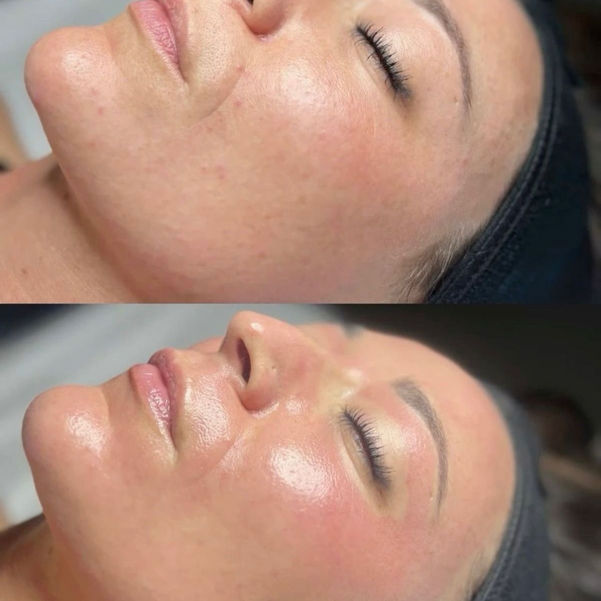 Skin Booster at Lumiee Skincare Llc in Chicago, IL