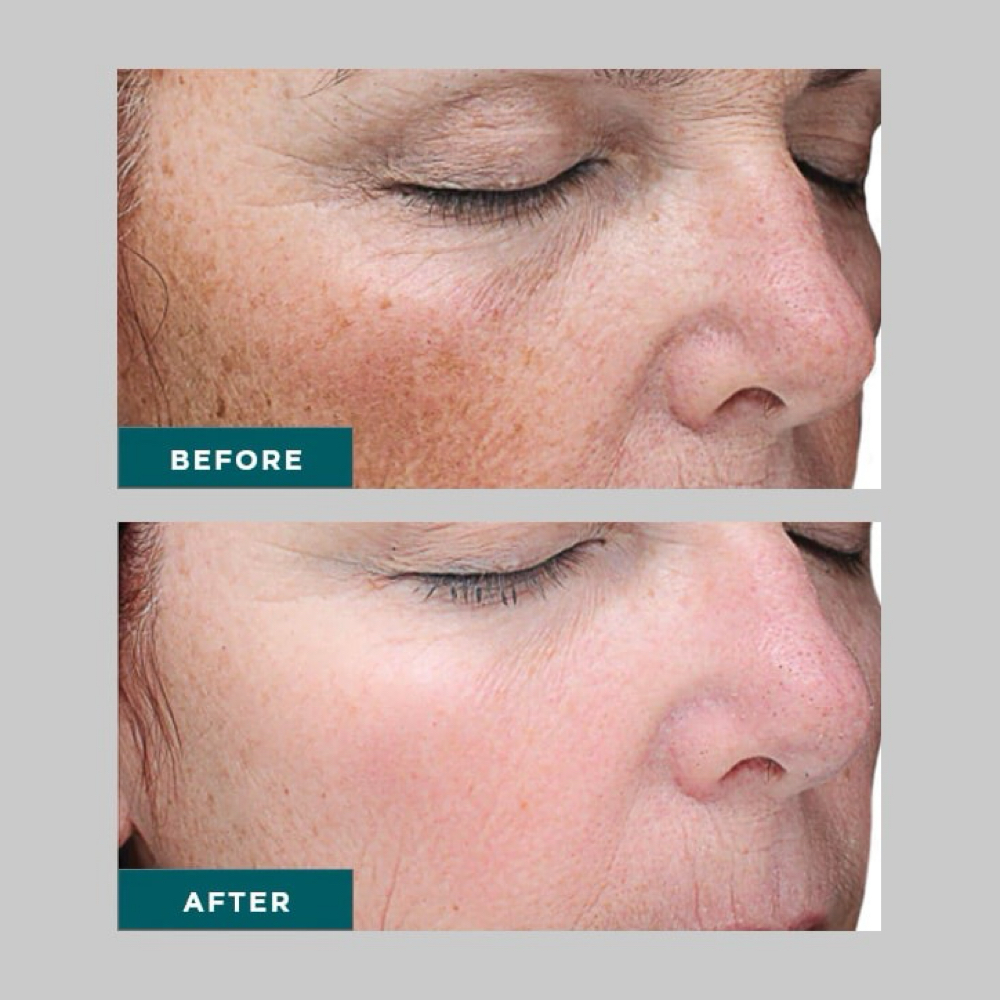 Chemical Special at Glo Skin Space in Crystal, MN