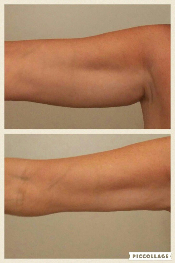 Arm Reduction