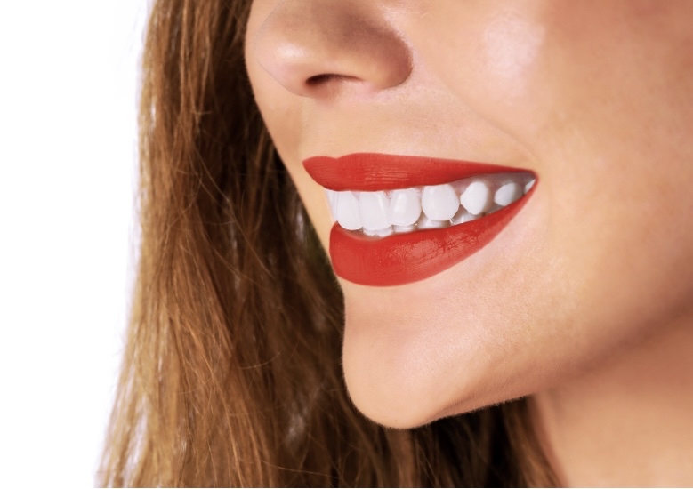 Teeth Whitening