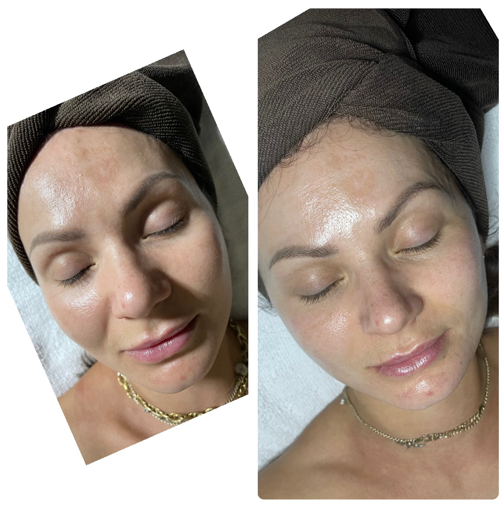 Face Lift