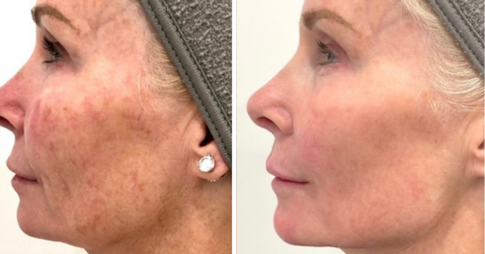 Co2 Laser Resurfacing