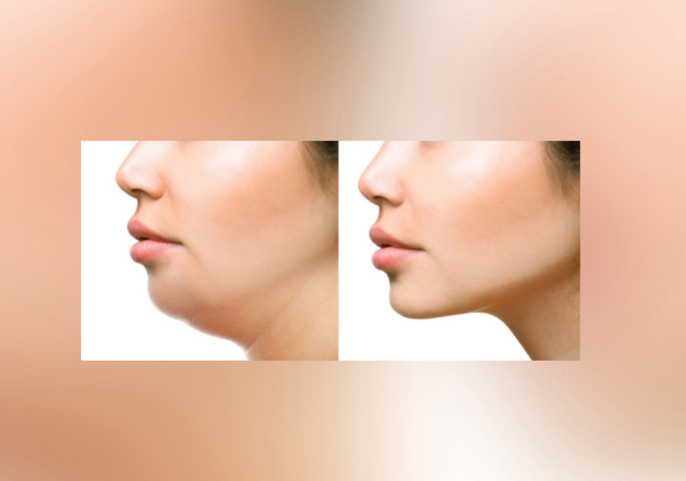 (1sess)Fat Dessolving Neck Area 🔥 at Bliss by criss llc in Buda, TX