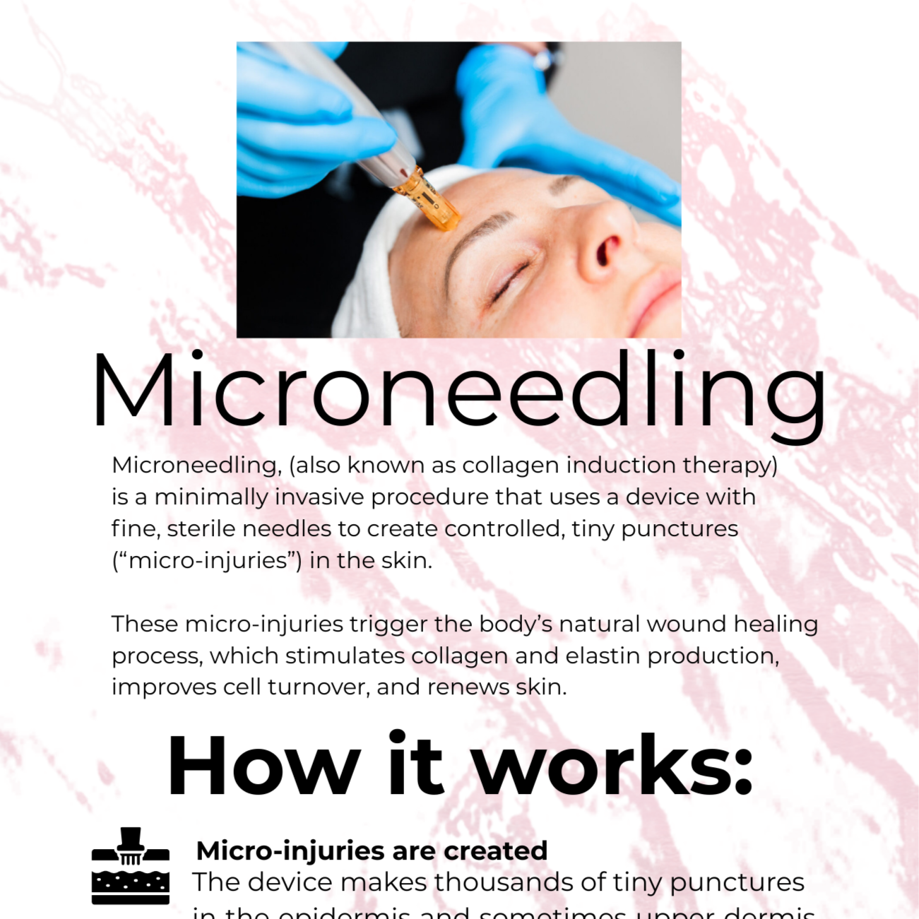 Micro-needling at Leann Renee Aesthetics in St. Peter's, MO