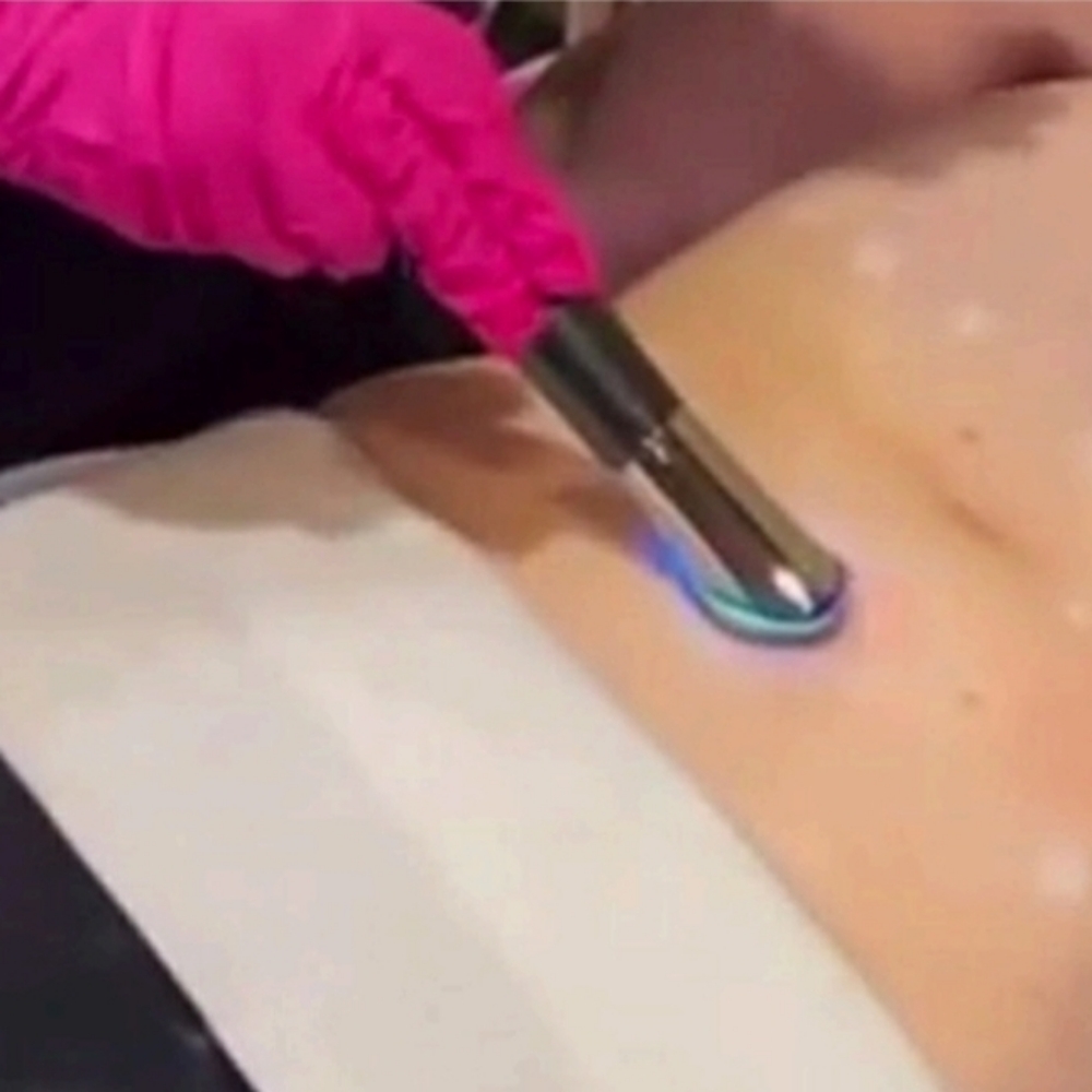 Fat Dissolve Model Call at Le Bar Beaute in Indian Trail, NC