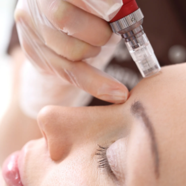 Micro needling - Salmon DNA PDRN at The Beautee Spot in Phoenix, AZ