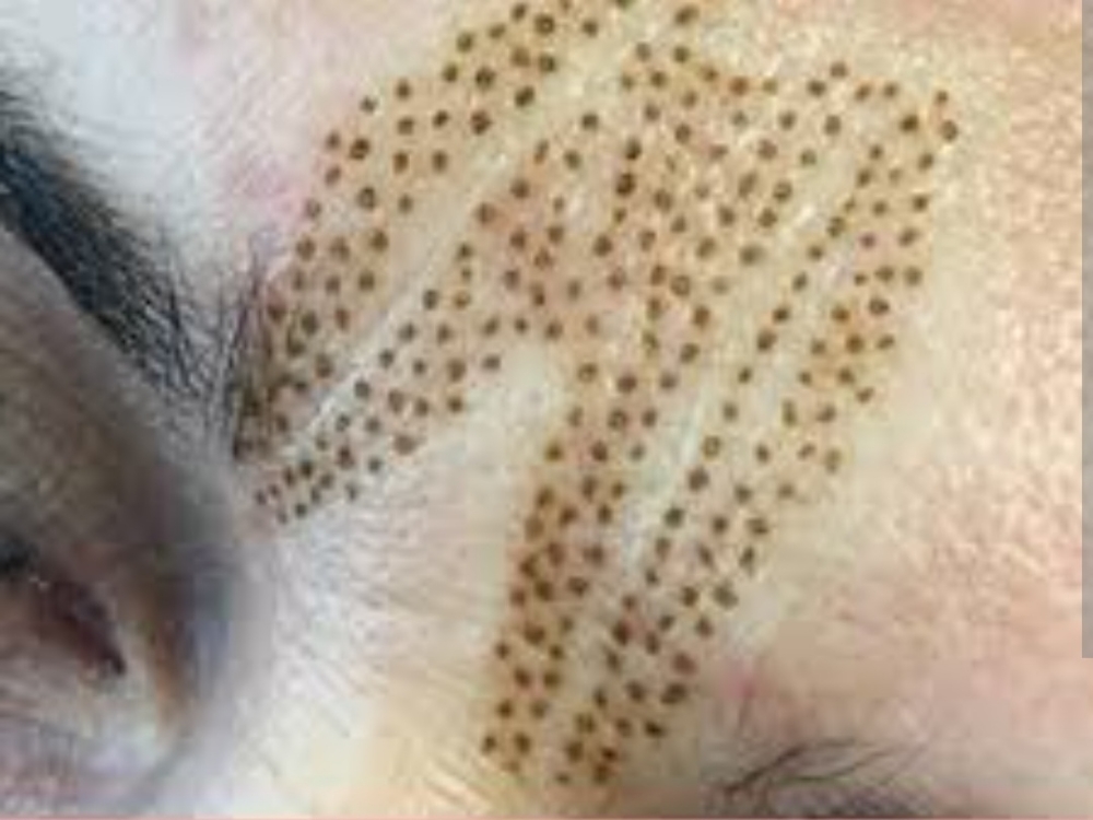 Plasma - glabella only