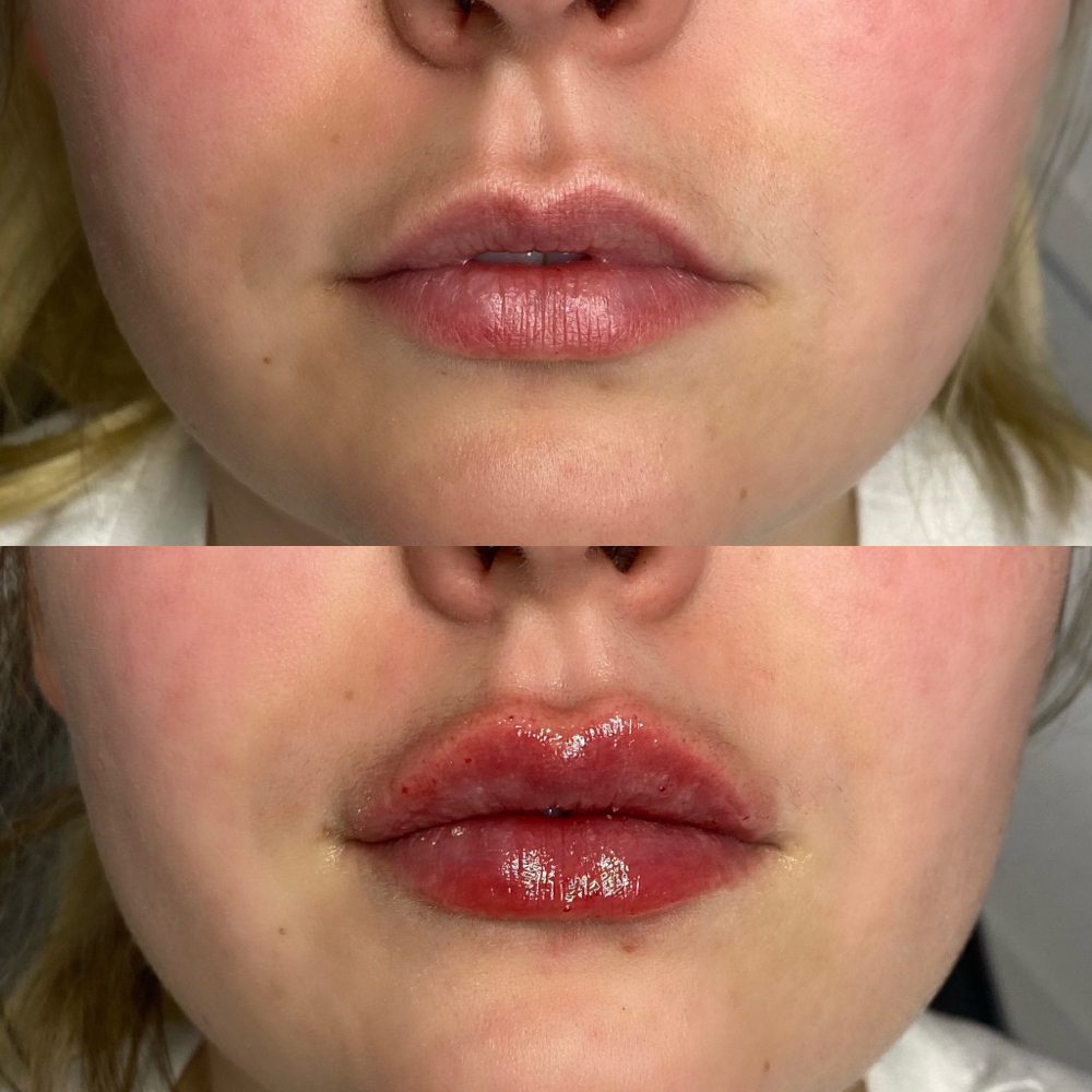 Glow Pen Lip Filler