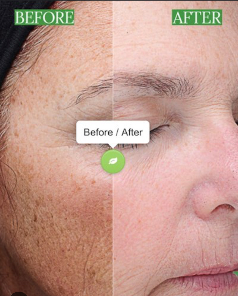 Chemical Peel