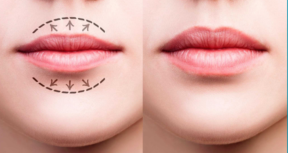 Fibroblast Lip Flip at Faces by DeAngela in New Brockton, AL