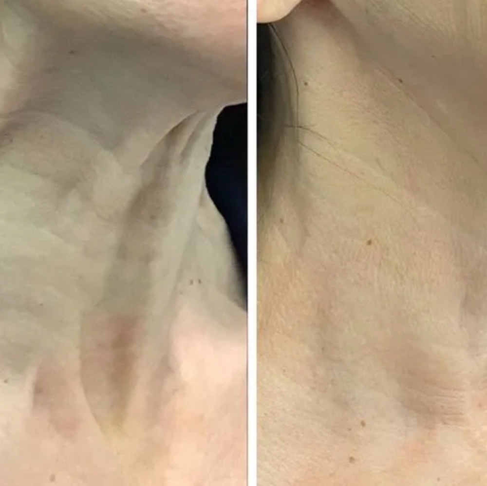 Neck Lift at Bliss Beauty Bar in Houston, TX