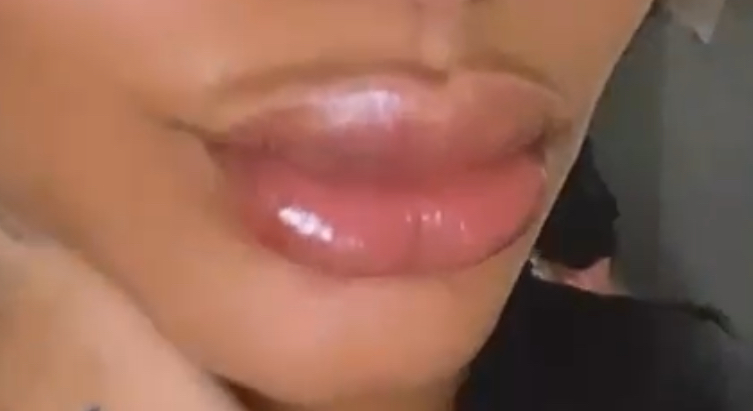 Vixen LIP FILLER 2ml